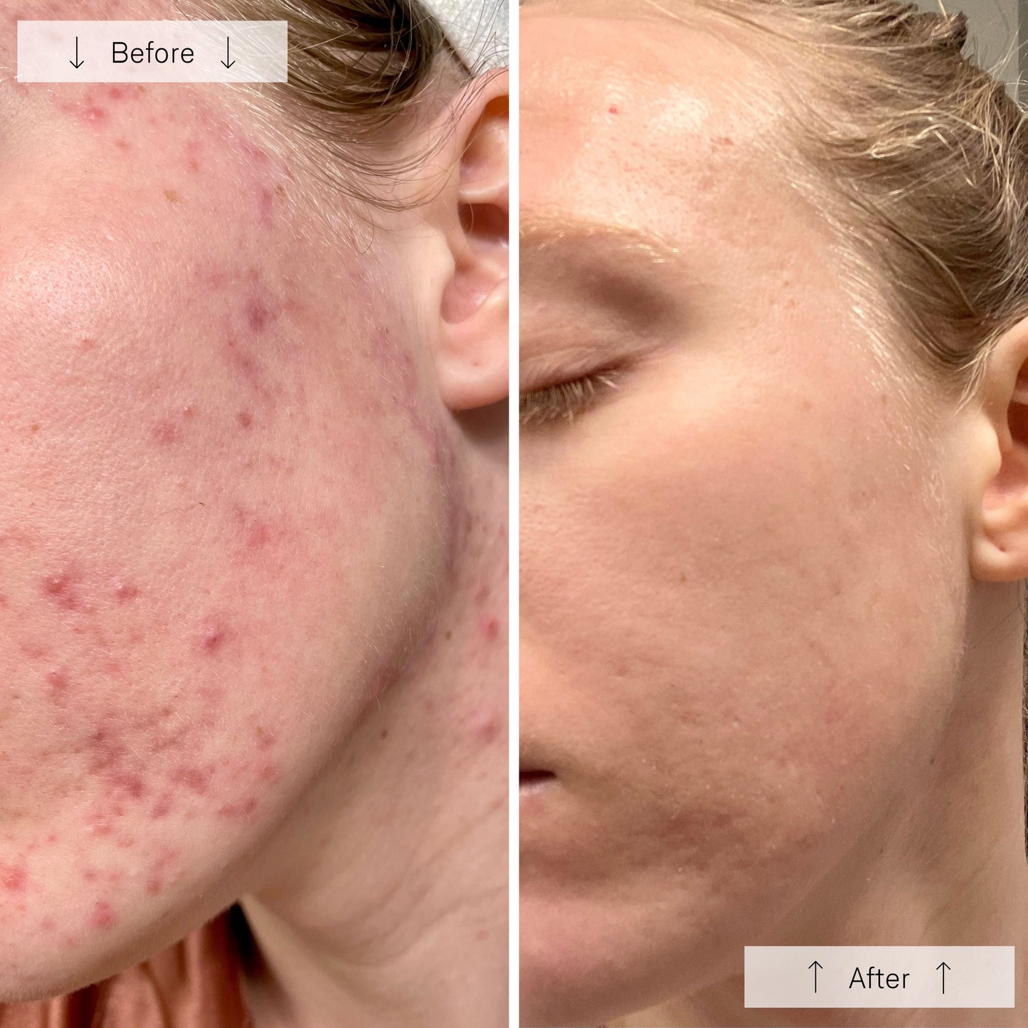 Omnilux Clear LED Skin Perfecting Mask
