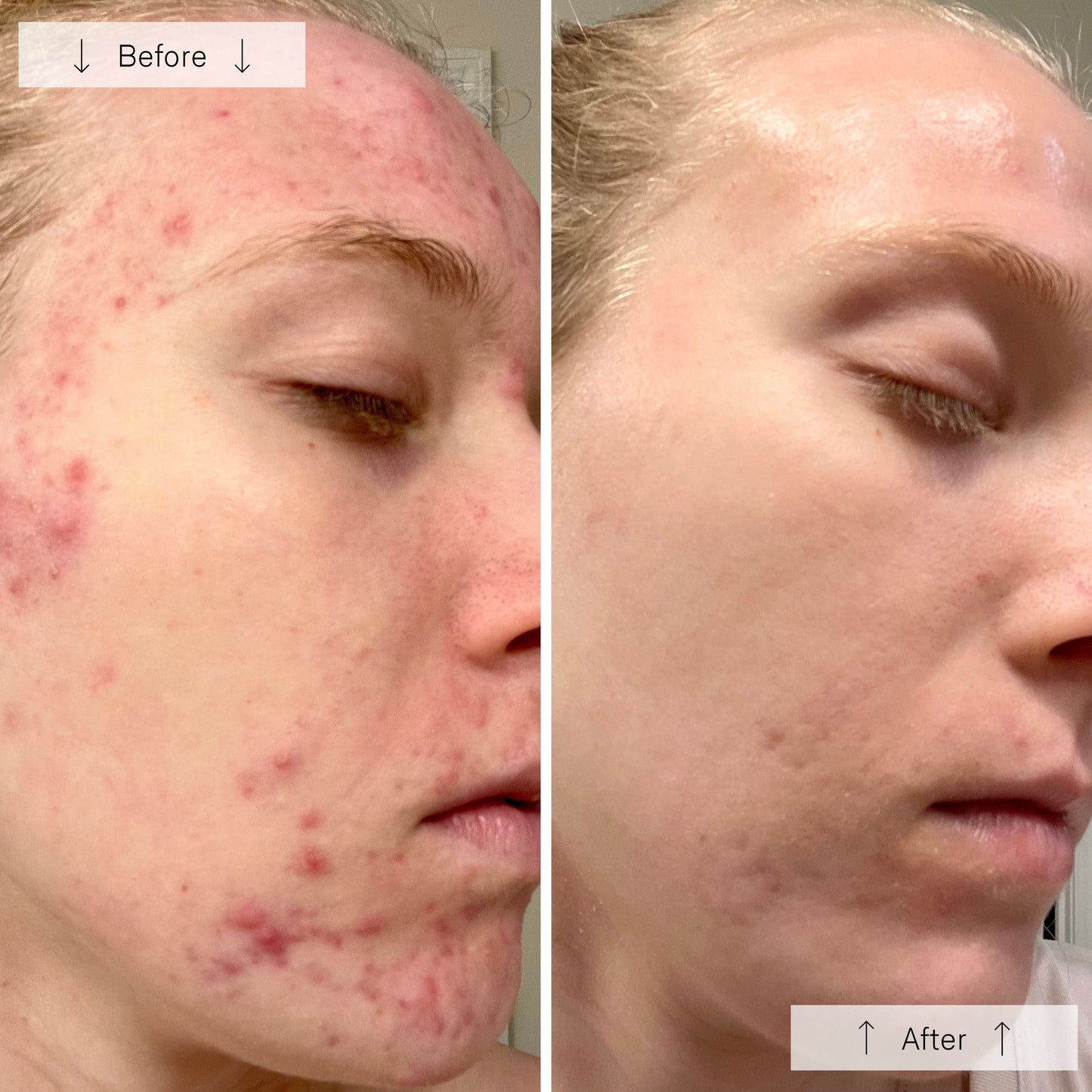 Omnilux Clear LED Skin Perfecting Mask