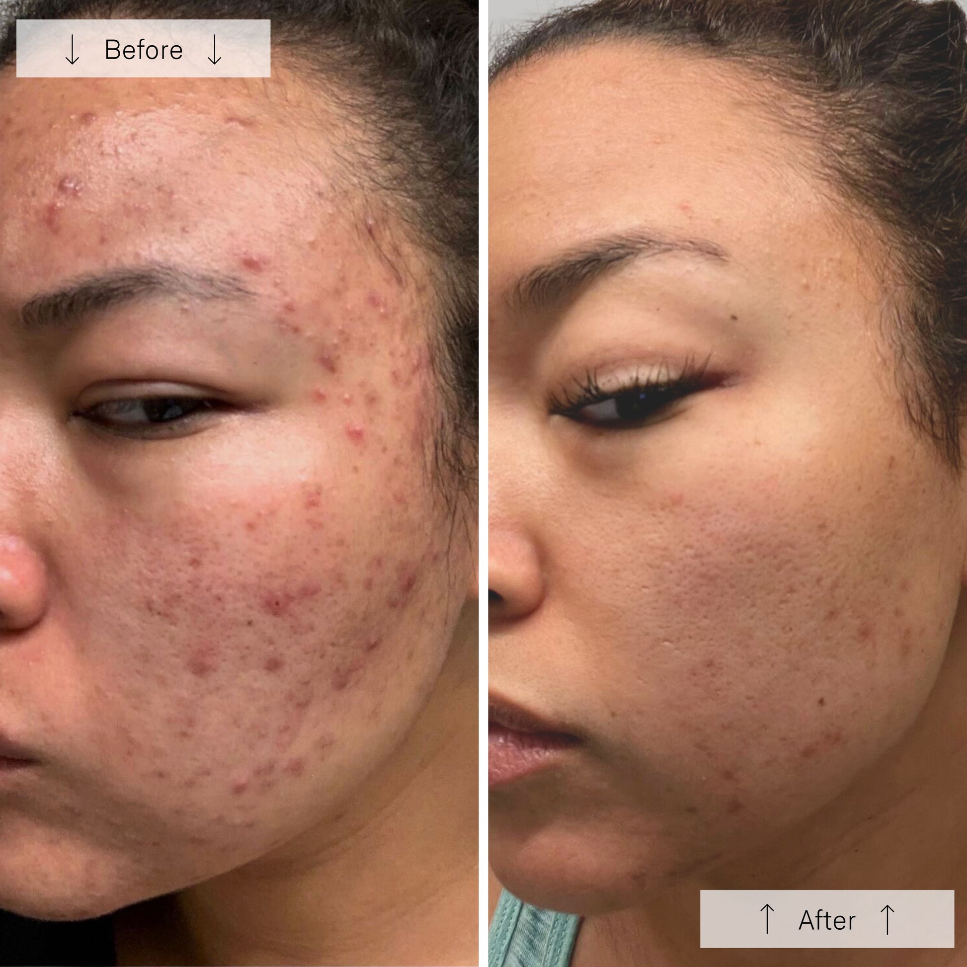 Omnilux Clear LED Skin Perfecting Mask