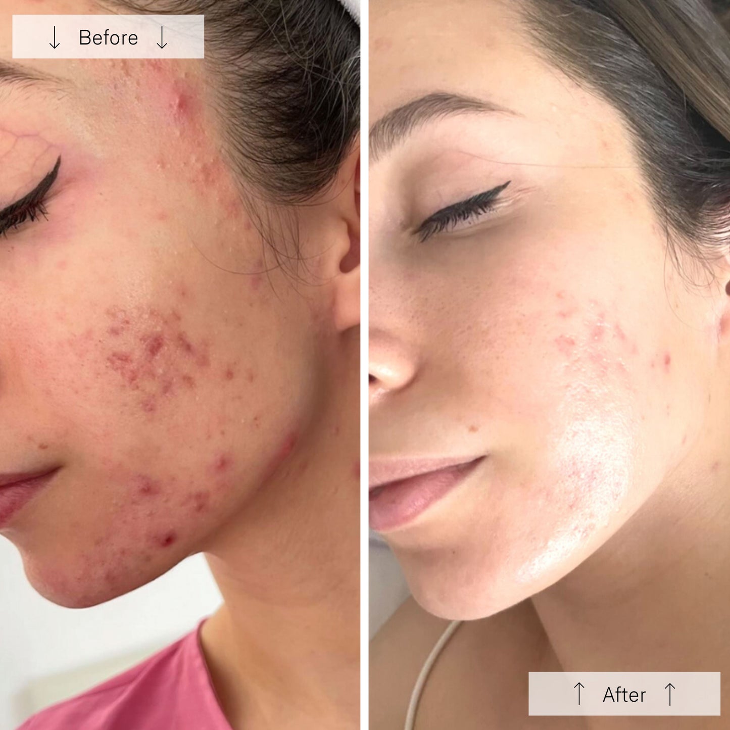 Omnilux Clear LED Skin Perfecting Mask