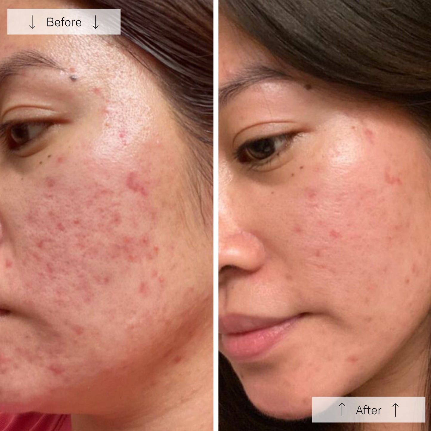 Omnilux Clear LED Skin Perfecting Mask