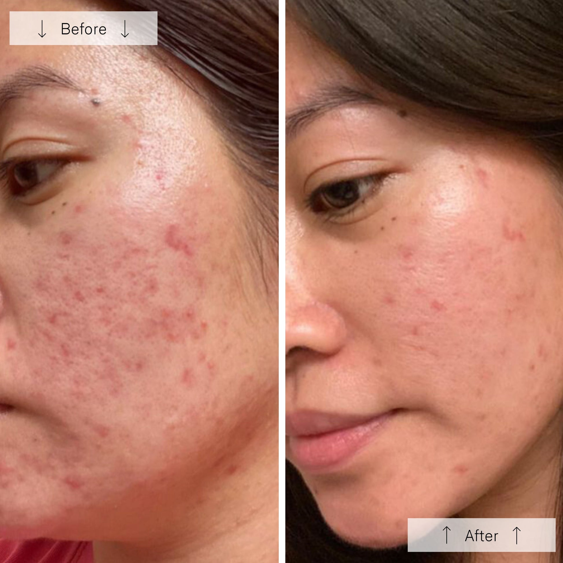 Omnilux Clear LED Skin Perfecting Mask